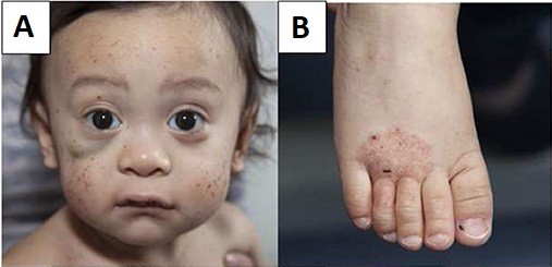 wiskott–aldrich syndrome petechiae, hematoma and eczema